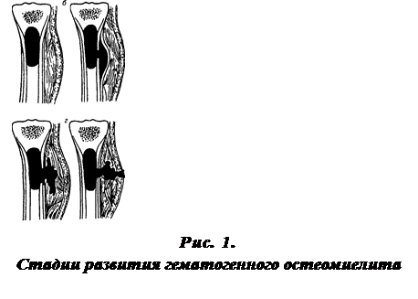 Острый гематогенный остеомиелит схема. Острый гематогенный остеомиелит патогенез. Патогенез гематогенного остеомиелита. Гематогенный остеомиелит этиология.